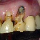 크라운 | 까매서 보기 싫은 앞니 충치, 지르코니아 크라운 교체 후기