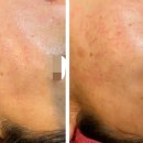 오닉스스킨테라피 이미지