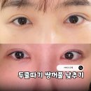따기네 | 쌍꺼풀 재수술 소세지눈 쌍수 눈매교정 두줄따기 2개월 후기와 흉터