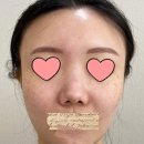 뭉툭 | [낮은코성형] 낮고 뭉툭한코 성형 3개월차 만족후기