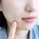 웰부스트 | 여드름피부 셀프피부관리 방법! 피지웰 글로우 케어 부스터 피지조절영양제 후기