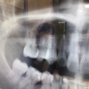 (주)바이콘임플란트 | 치과치료일기/어금니 임플란트 후기, 뼈이식 치료하고 있어요.