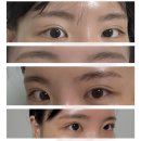 안도스테이 | [스테이무아] 인천 눈썹문신제거 잔흔제거 후기 인천 아이라인문신제거 잘하는 곳