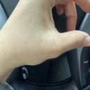 동남아 베트남 손등 얼룩 반점 기미 접촉성피부염?아니 식물성광피부염! 두 달간 변화