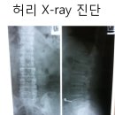 거위발 점액낭염 Anserine bursitis 치료 사례 이미지