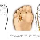 몰톤신경종(Morton's Neuroma)의 침술치료 이미지