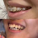 또, 올개 | 광주 앞니 부분교정 기록-2 ‘내돈내산 후기’ 완전 만족중