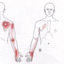 * 근막통 증후군 (상후거근) 이미지