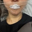 한피부과의원 | 레스틸렌키스 입술필러 신논현피부과 ㅇㄷ의원 한달 후기 전후사진