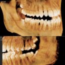 위례스마일치과의원 | 방학 때 사랑니 빼는 분들, 다 이유가 있습니다, 북위례 이아소치과