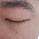 무제한편평사마귀 제거 명동한의원 내돈내산 후기와 비용