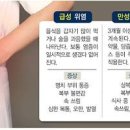만성 표재성위염 헷갈리기 쉬운 증상 3가지 이미지