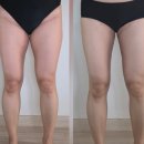 달달하개 | 안양평촌 허벅지 지방추출주사 3주 후기 | 붓기와의 전쟁