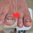 멜팅크네일룸 | 레푸스에서 다시 시작한 발톱 관리 후기