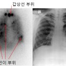갑상선암 방사성동위원소 스캔 검사 I-123 은 어떤 검사이며 결과 수치는 어떻게 해석하나요? 이미지