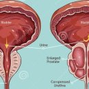 전립선 비대증과 전립선암 이미지