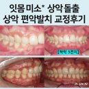 전치 앞(2) | 상악 돌출, 잇몸 미소를 가진 경우의 편악 발치교정 후기 [하악 3전치]
