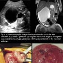 Prenatal Detection of a Congenital Pancreatic Cyst by Ultrasound 이미지