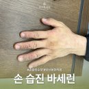 청아한의원 | 당산역 한의원 여름 손 습진 바세린 수포 치료 후기 찾고 있다면