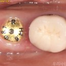 e사랑치과의원 | 광교 치과, 부러진 어금니 발치 즉시 임플란트 ;뼈이식+지르코니아