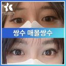 명인외과의원 | 쌍수, 매몰쌍수와 절개는 어떻게 선택할까? 눈매교정술·안검하수수술비용까지
