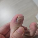 셀프케어 테이핑 건강교실 | 내성발톱이 고민이세요? 경산무좀발톱 내성발톱케어 경산치유네일 사동점 후기