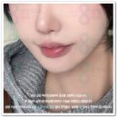 브이웰마취통증의학과의원 | 미니거상 비용 및 효과 후기 체크, 회복기간까지 알아보자