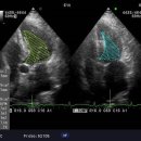 Atrial fibrillation with abnormal septal wall motion 이미지