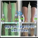 무지외반증 이숙경발가락교정기 3개월 착용후기