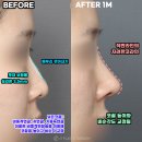 JT빌딩 | 메부리코성형 자려한 직반라인 코 후기_제이티성형외과