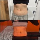 부여비비안 | 압구정피부과 바디온다·비비안 지방분해주사 내돈내산 후기｜옆구리 라인 관리 2주 변화
