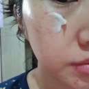 끌림365의원 | 끌림365평촌에서 받은 화이트닝프로그램 IPL후기에요