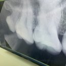 첨단튼튼치과의원 | 광주 아프지 않게 첨단 ‘튼튼치과의원’ 사랑니 발치|스케일링|금액|보험