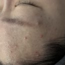 청심로 | 메디스킨 유리하 여주피부관리 홍조 여드름 건조피부 관리받고 달라진 피부 후기