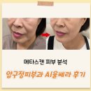 아이캔커피(한대앞역점) | 압구정피부과에서 메타스캔 피부분석 받고 AI울쎄라 시술받은 후기