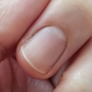 (주)아메리칸트레일러 대구동산의료원점 | 10월 3주차 일기(feat.생손=조갑주위염 치료)