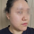 원대병원 앞(북일초등학교 방향) | 볼모공 자가진피재생술로 엘라비에 리투오 3cc와 트리필프로 진피절제술을 받은 후기