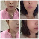 위례서로 | 위례 리프팅 볼뉴머 600샷 후기 전후사진 있음