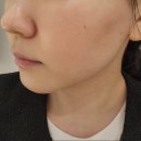 여름의원 | 여름의원 포텐자 받고왔어용 ::시술 전후 비교 &amp; 만족도 후기::