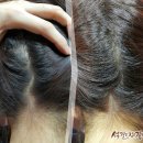 헤나 염색으로 지루성두피염 관리한 후기◁