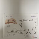 서울에스유외과 맘모톰 후기 기록 (비급여 / 조직검사 후기)🛏️