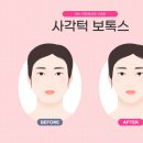 미사보톡스 사각턱, 웃을 때 도드라지는 자갈턱의 정체
