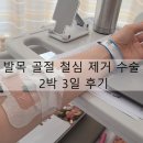 발목 골절 철심 제거 수술 후기