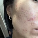 소창한의원 | 한쪽만 나는 뾰루지 복구 -ing