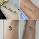 10 | 부산 타투제거 9회차 후기｜10년 지난 손목 타투 변화 과정