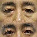 두려움을 제거하는 가장 빠른 방법 | [산청하동눈밑하안검] 눈밑하안검 수술 전 꼭 알아야 할 핵심 정보
