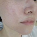 플라즈마 전문 운정 피부관리샵 <와이제이뷰티> 물방울 리프팅 후기✨️
