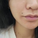 [청주/가경동] 한의원에서 점 뽑아본 사람있어요? 이츠미+ (피브로한의원)