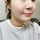 (주)포트라 | 여의도 피부과 콰트로 리프팅 (티타늄 플러스), 플라듀오 후기