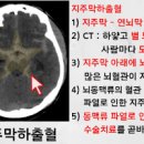 뇌출혈 초기증상 뇌출혈 코피 뇌출혈 원인 골든타임 후유증 이미지